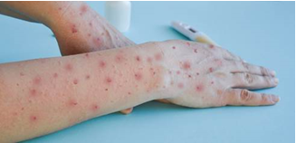 Kenali Mpox dan Cara Melindungi Anda dan Keluarga